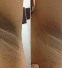 lighten armpits